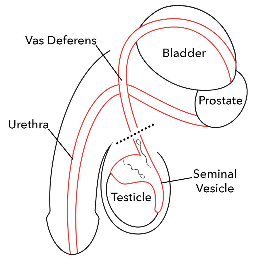 Vasectomy